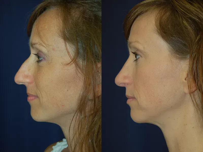 Rhinoplasty Before & After