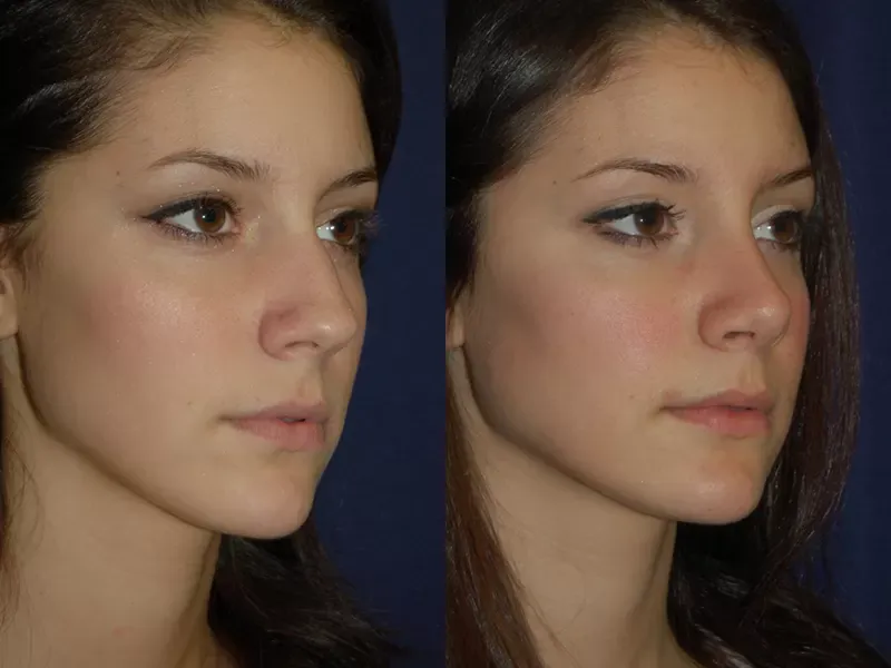 Rhinoplasty Before & After