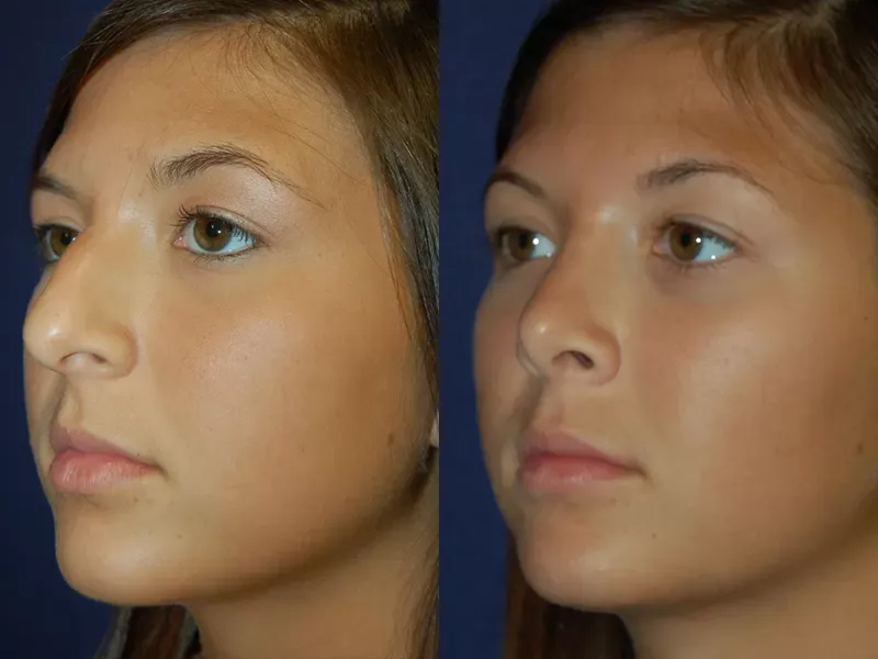 Rhinoplasty Before & After