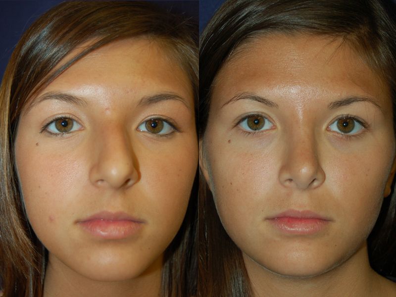 Rhinoplasty Before & After