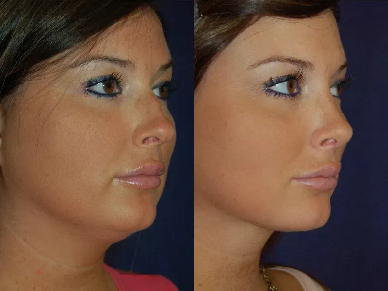 Rhinoplasty Before & After