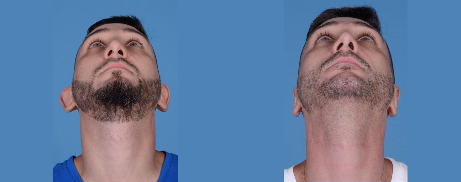 Rhinoplasty Before & After