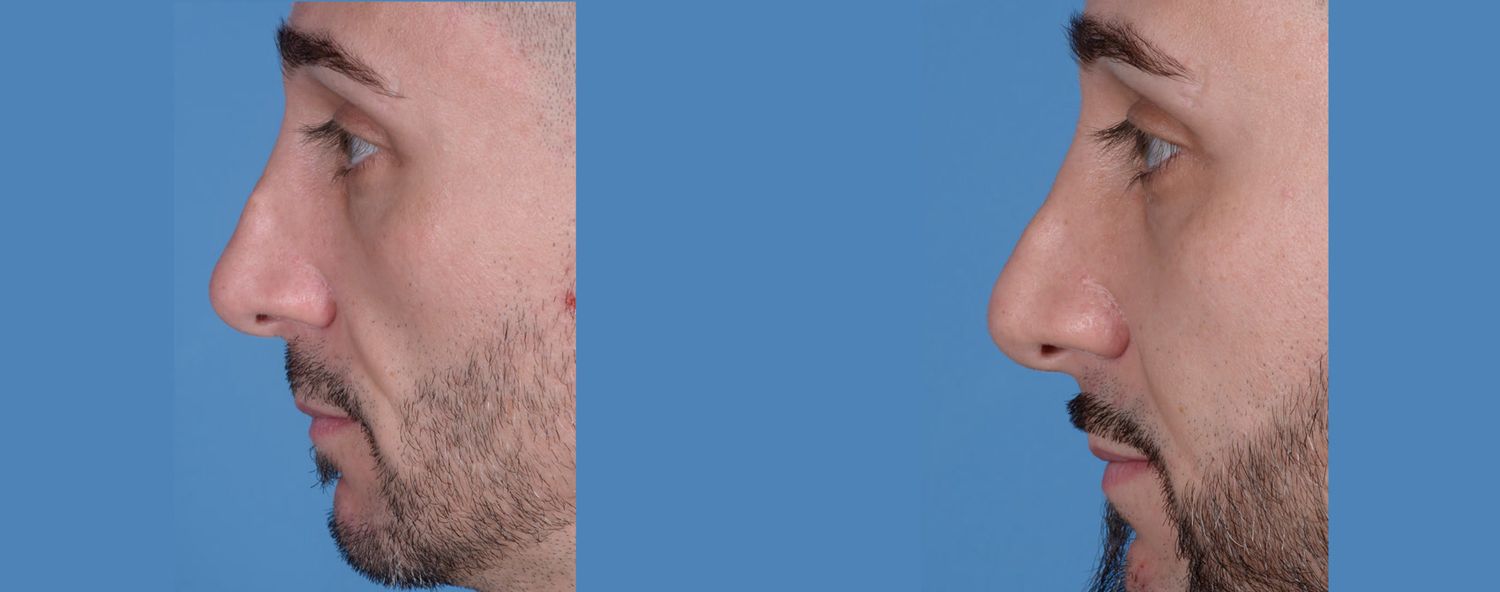 Rhinoplasty Before & After
