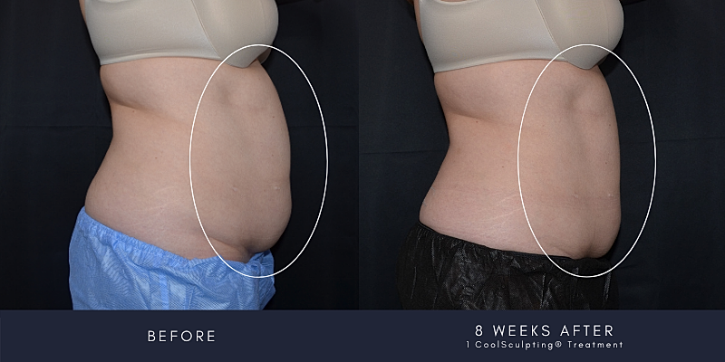 Coolsculpting Before & After