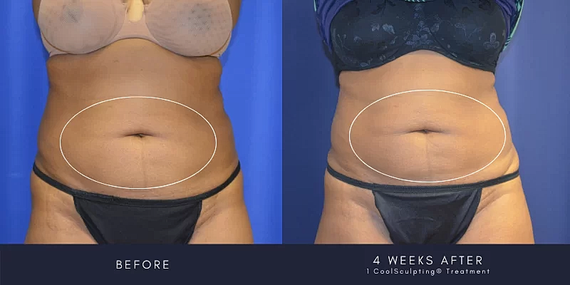 Coolsculpting Before & After