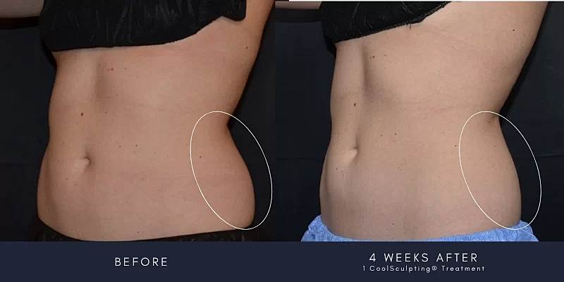 Coolsculpting Before & After