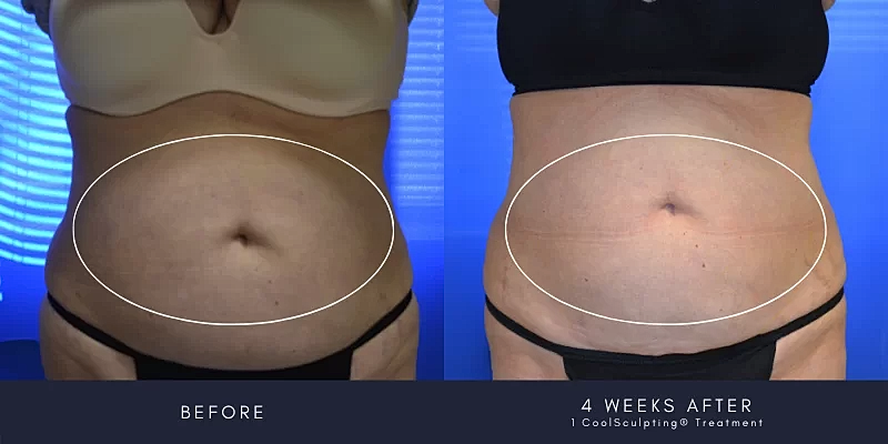 Coolsculpting Before & After