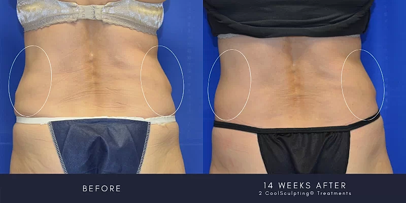 Coolsculpting Before & After