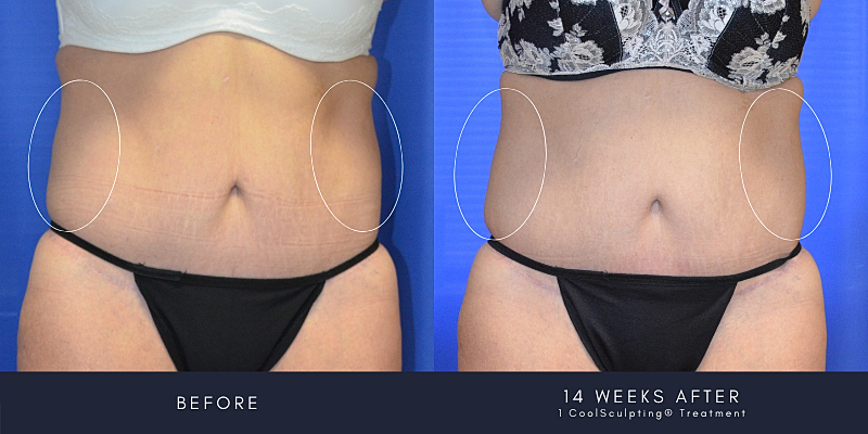 Coolsculpting Before & After