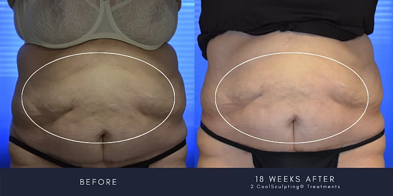 Coolsculpting Before & After