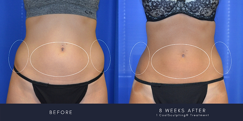 Coolsculpting Before & After
