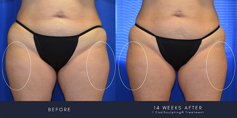 Coolsculpting Before & After