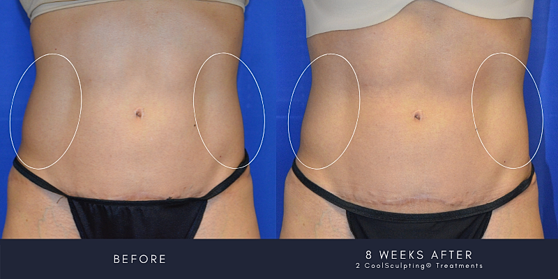 Coolsculpting Before & After