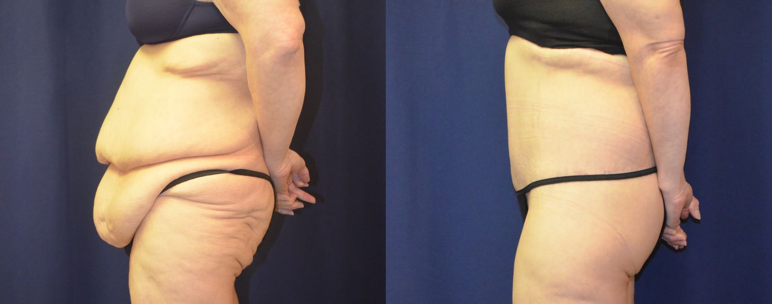 Body Contouring Massive Weightloss Before & After