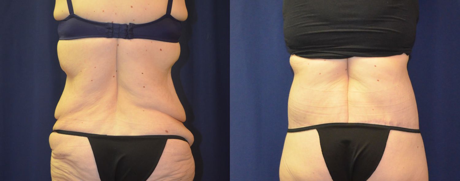 Body Contouring Massive Weightloss Before & After