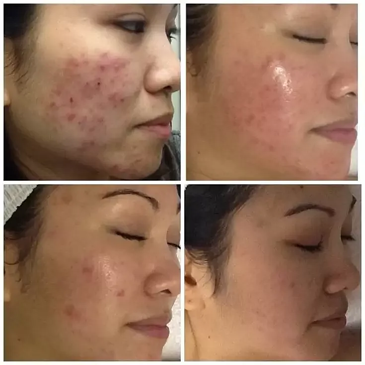 Before and after acne treatment photos.