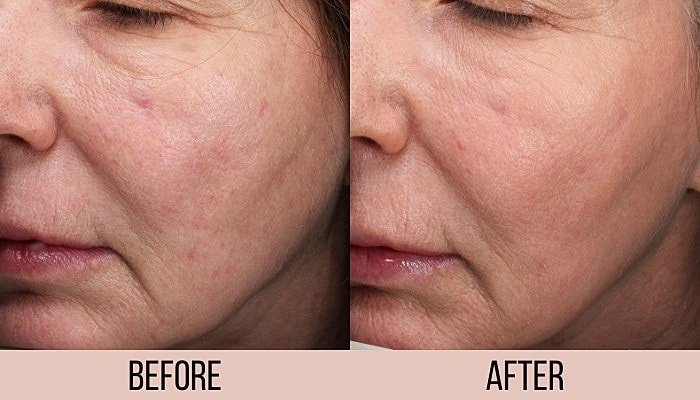 Skin improvement before and after treatment comparison.